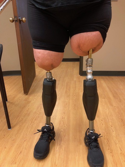 HPC has seen many Osseointegration patients.